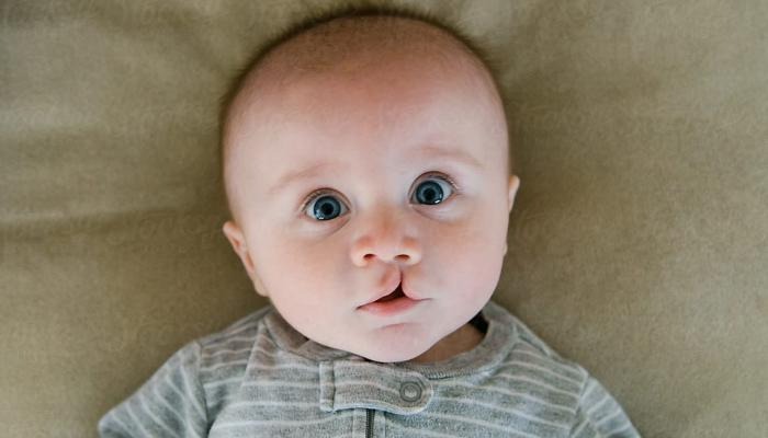 Pediatric Cleft Lip Reconstructive Surgery